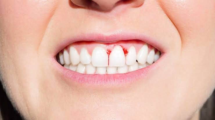 bleeding gums causes and treatment