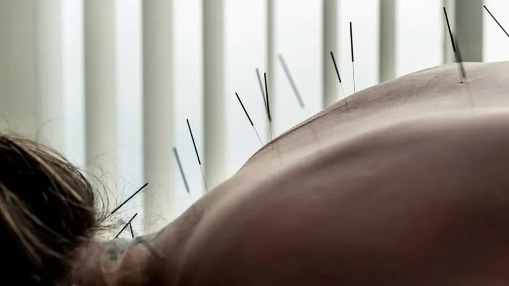 does acupuncture work