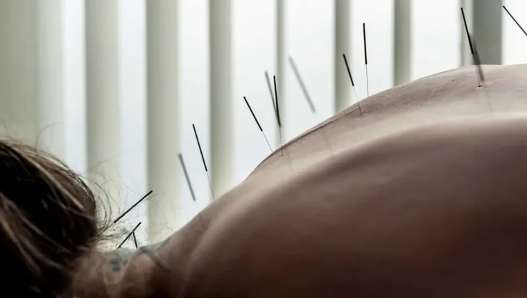 does acupuncture work