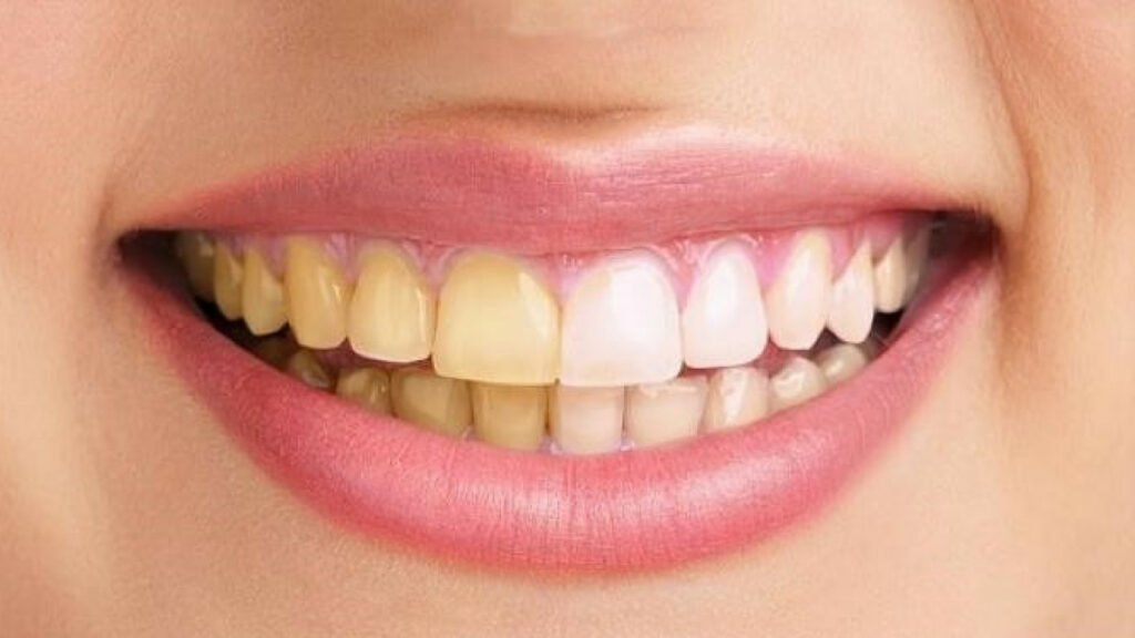 natural teeth whitening at home