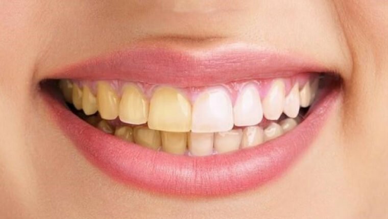 natural teeth whitening at home