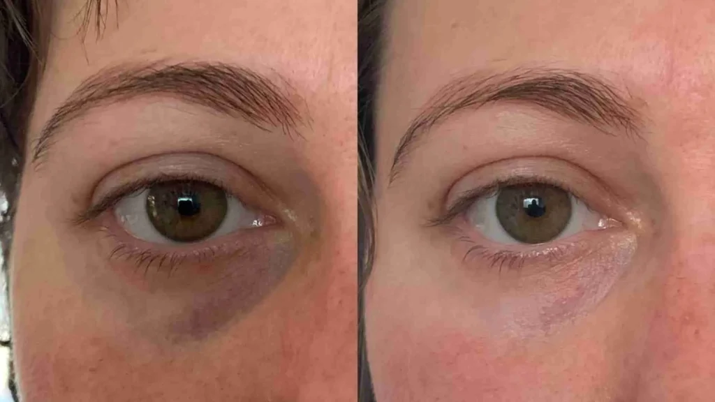 remove dark circles naturally