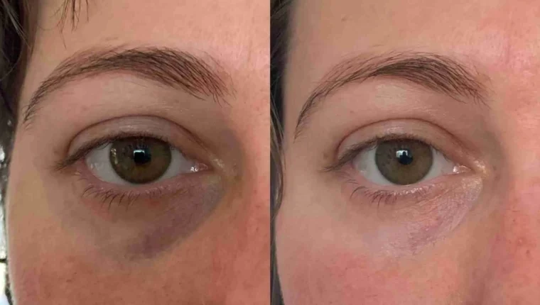 remove dark circles naturally